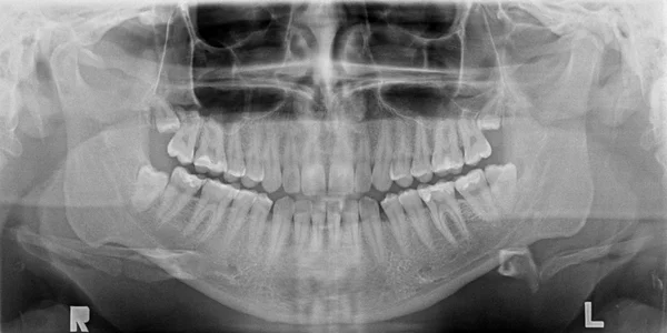Panoramic x-ray image of teeth