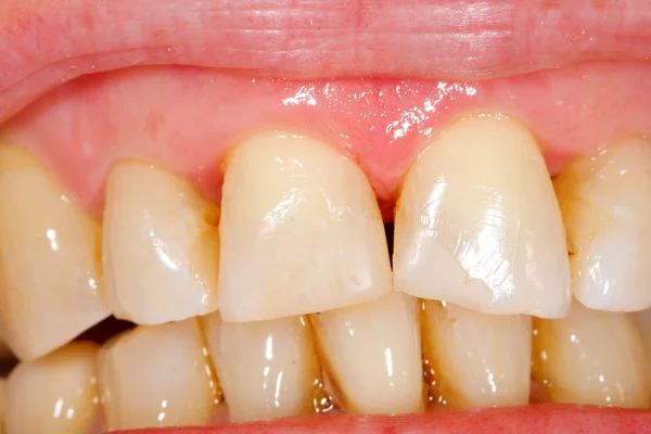 Composite filling tooth treatment