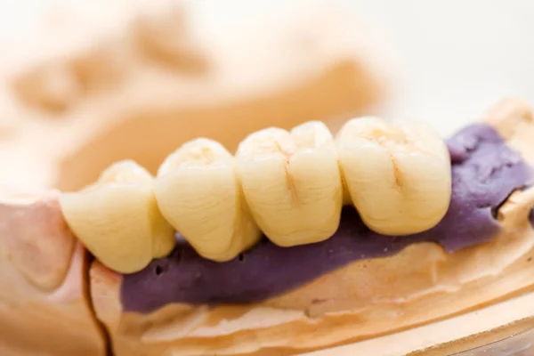 Dental bridge made of porcelain on casting