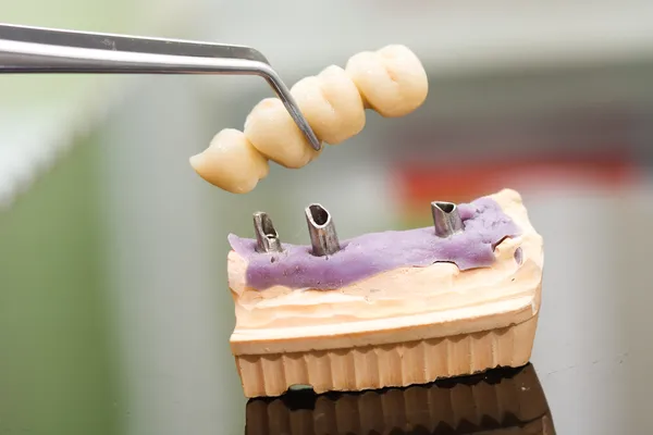 Dental implant head and bridge