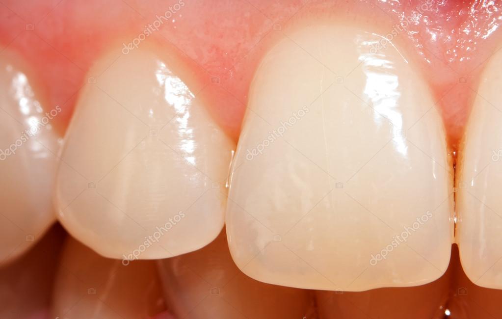 Cracked Enamel On Tooth windowget