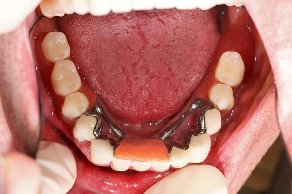 Lower Prosthesis In Mouth