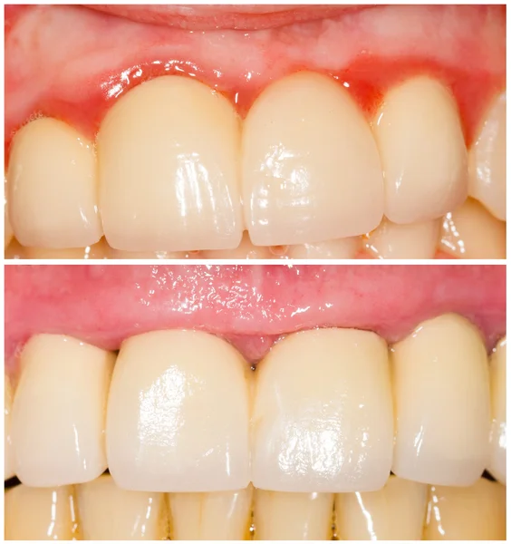 Buffing Teeth Tangent and with Shoulder