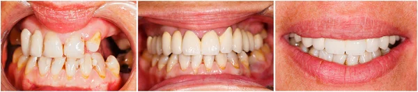 Teeth before and after treatment