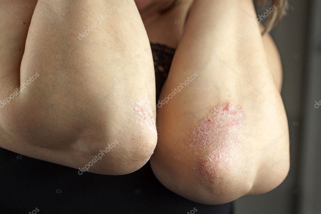 Le psoriasis des organes génitaux les préparations pour le traitement