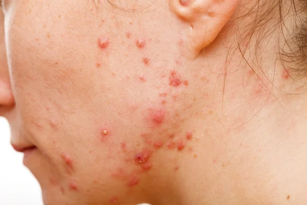 Acne skin