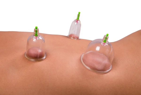 Cupping therapy