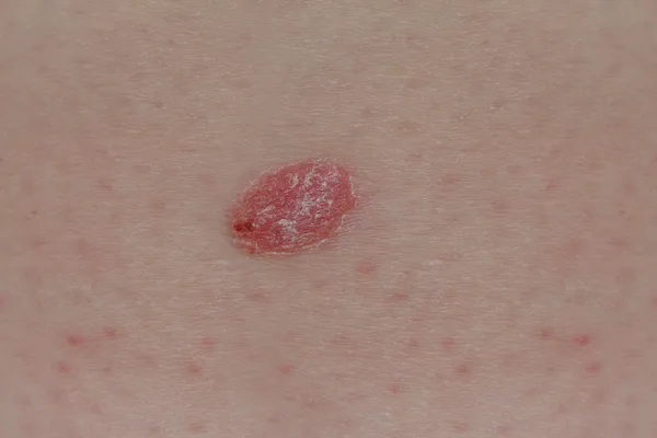 Psoriasis