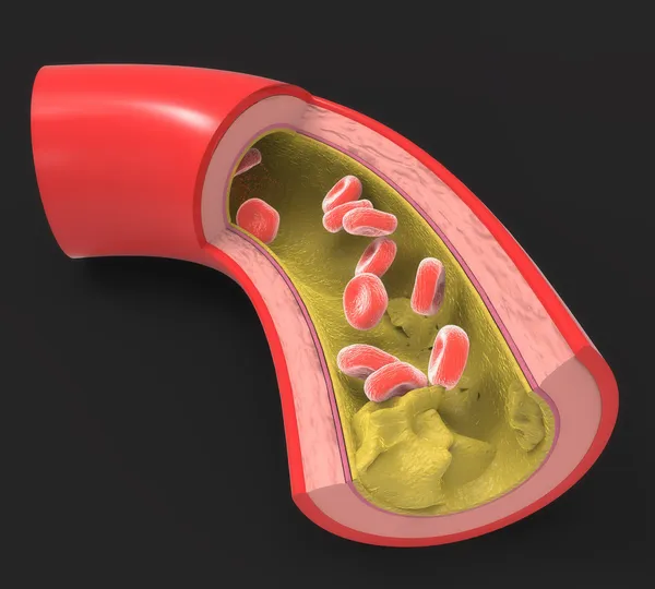 Diseased artery with fatty deposits