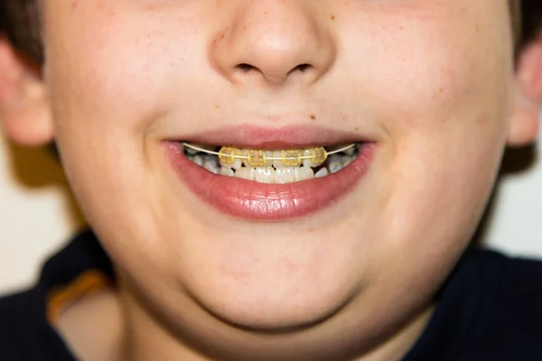 Braces and white teeth of smiling boy