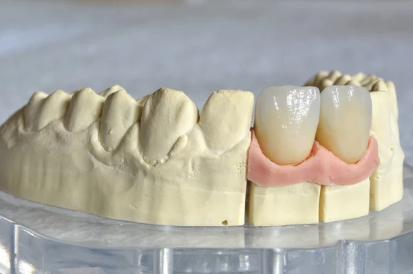 Dental prosthesis, upper incisors