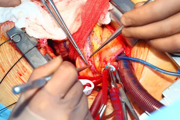 Heart surgery. Coronary artery bypass surgery. The most common h