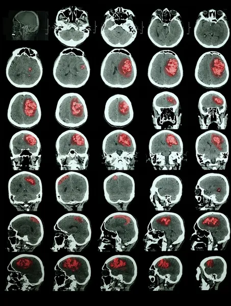 CT of the brain with hemorrhagic stroke. Professional training i