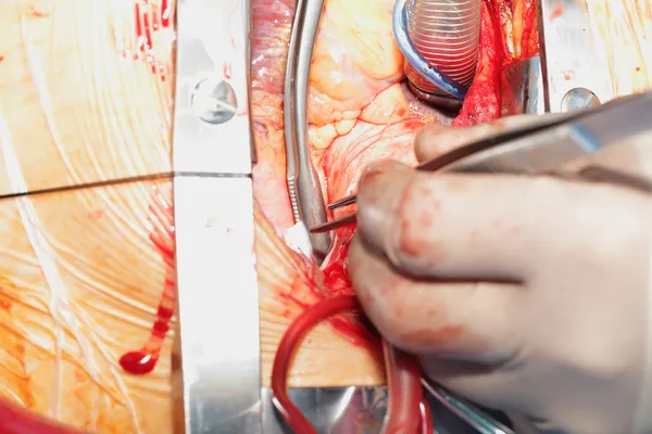 Heart surgery. Open heart surgery. Coronary artery bypass surger