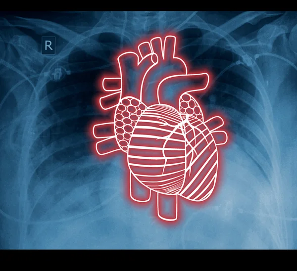 Chest x-ray and heart. The idea for the medical concept