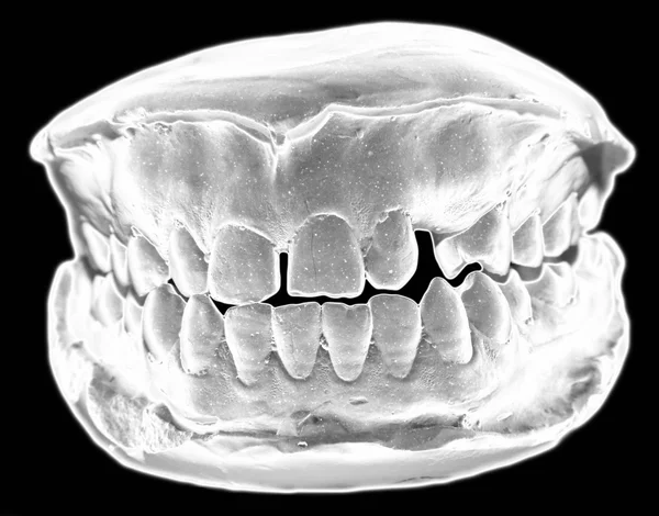 The view of dental cast,front,for education