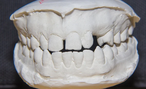 The view of dental cast,front