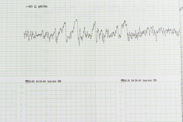 Medical findings graph. Irregular lines on the green grid.