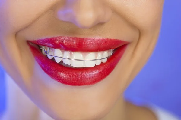 Beautiful smiling girl with retainer for teeth, close-up (on a b