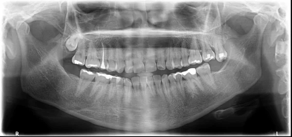 X-Ray of a mandible