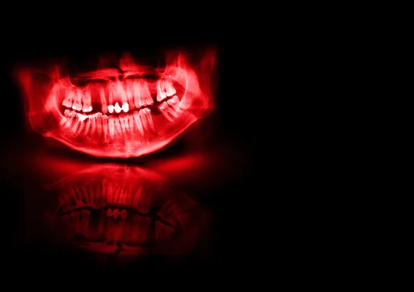 Black and red x-ray teeth scan mandible. — Stock Photo #24187717