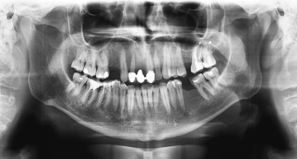 Black x-ray teeth scan mandible.