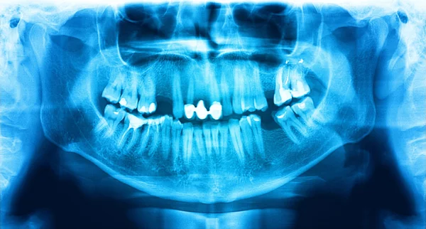 Blue red x-ray teeth scan mandible.