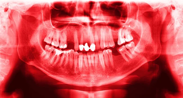 Red x-ray teeth scan mandible.