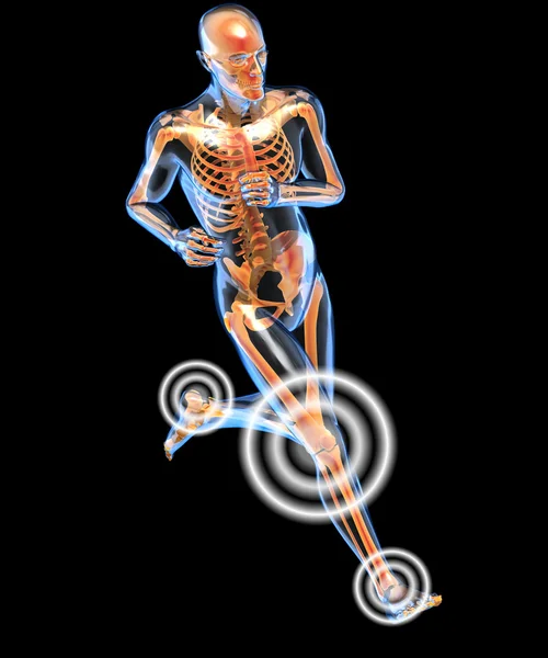 Running man seen by x-ray with pain in the leg