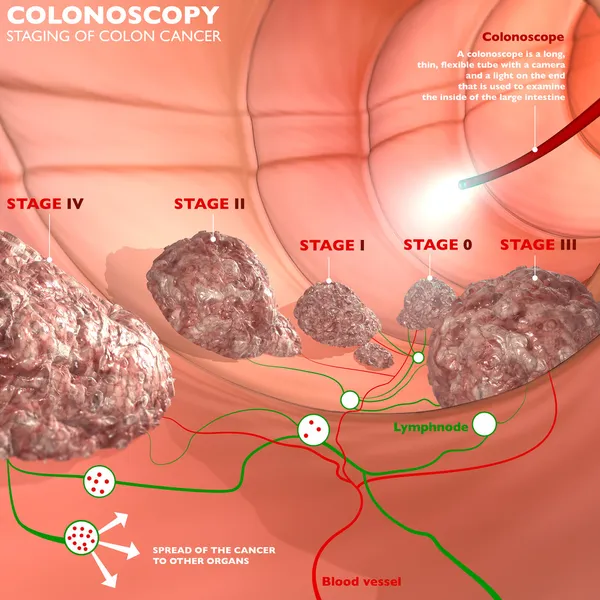 Colonoscopy digestive system