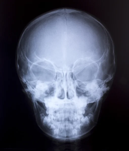 X-Ray Image Of Human Chest for a medical diagnosis