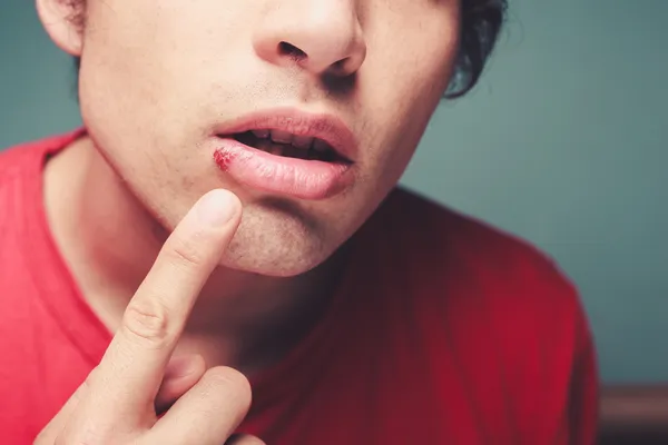 Young man with cold sore