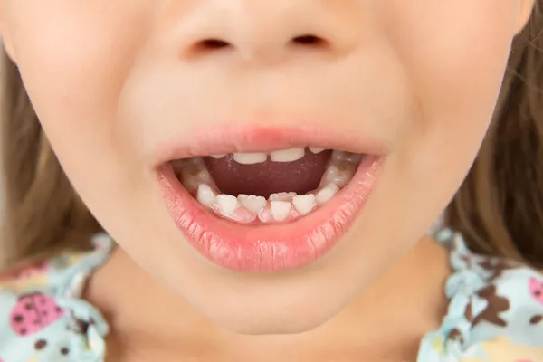 Open mouth of a little girl with calf\'s and permanent teeth
