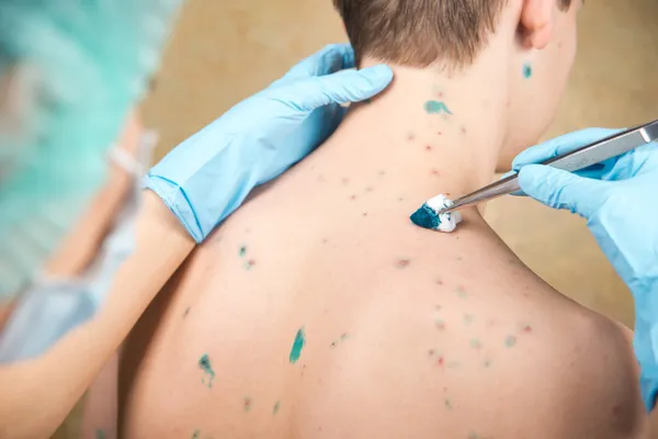 Chickenpox. Skin rash. Viral disease.