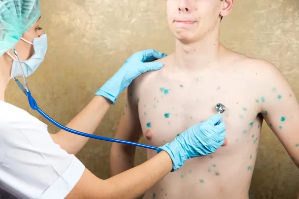Chickenpox. Skin rash. Viral disease.