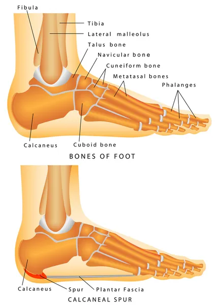 Heel Spur.