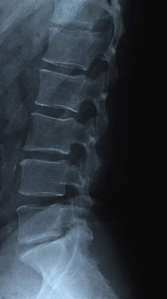 Spine radiograph