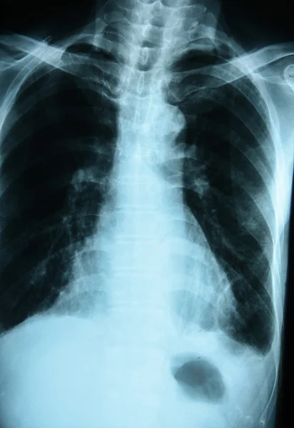 X-Ray Image Of Human Chest