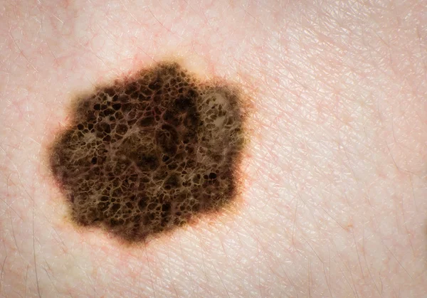 Melanoma, skin cancer, mole. High definition image.