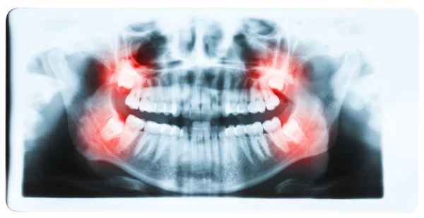 Panoramic x-ray image of teeth and mouth with all four molars ve