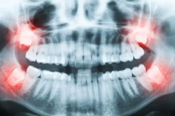 Closeup of x-ray image of teeth and mouth with all four molars v