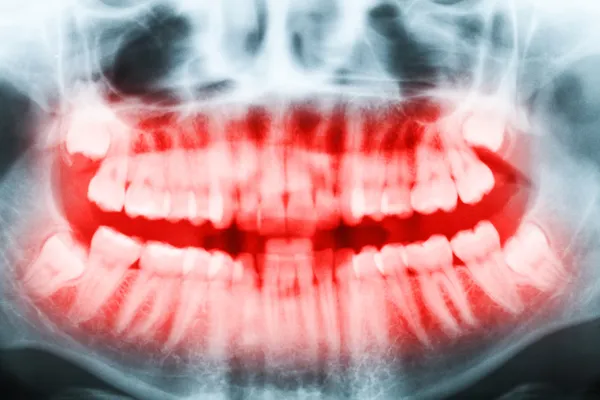 Close-up x-ray image of teeth and mouth with all four molars ver