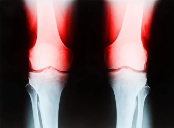 X-ray of a senior male right and left knee showing tibia and fib