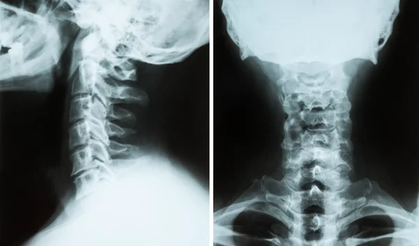 Composite of two X-ray images of a cervical spine(neck) of a sen
