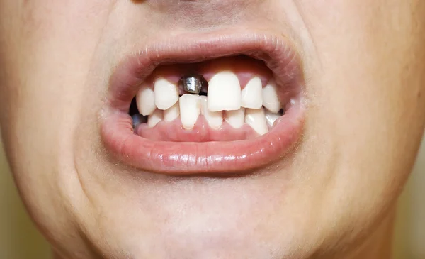 Dental prosthesis