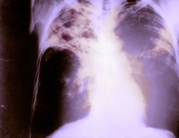 Bilateral pulmonary tuberculosis