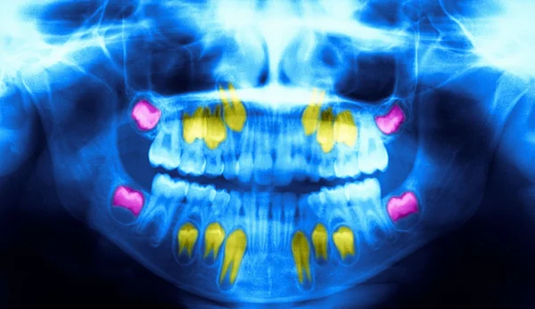 Dental panoramic x-ray
