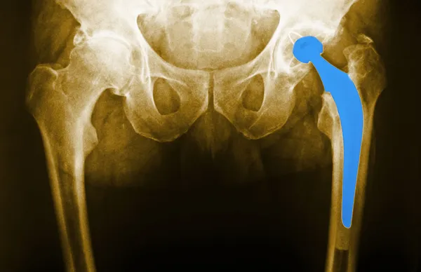 Man's hip radiograph