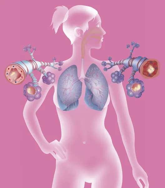 Depiction of a healthy bronchial tube