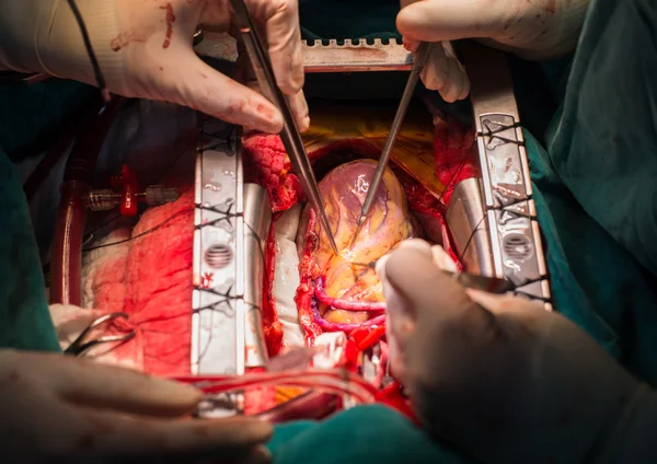 Coronary artery bypass grafting open left anterior descending artery